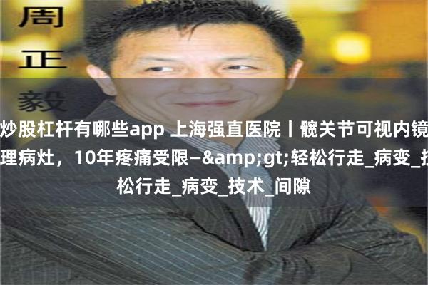 炒股杠杆有哪些app 上海强直医院丨髋关节可视内镜下精准清理病灶，10年疼痛受限—&gt;轻松行走_病变_技术_间隙